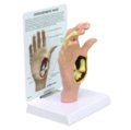 Osteoartritinės rankos modelis