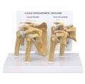 Osteoartritinio (OA) peties modelis - 4 stadijos