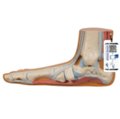 Pilnapadės pėdos (Pes Planus) modelis
