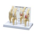 Šuns osteoartritinio kelio sąnario modelis, normalus + 3 patologinės būklės